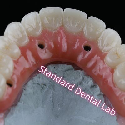 خرید تاج ایمپلنت دندانی PFZ برقی زرکونیا لایه دار با آدامس صورتی ساخت آنلاین
