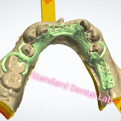 خرید طراحي قاب فلزي چاپ ليزري گچ کروم پروتز جزئي ساخت آنلاین