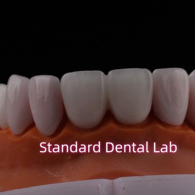 خرید لامپ های لامیناتیزه ترانسپانسنت Emax Zirconia لامپ های دندانپزشکی پورسلین از نظر شیمیایی قابل انعطاف است ساخت آنلاین