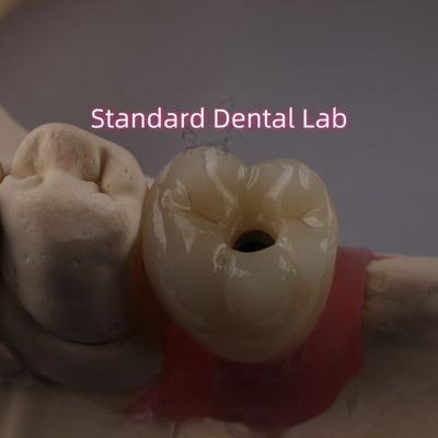 خرید تاج ایمپلنت دندانی بسته به پیچ PFZ زرکونیا لایه دار ساخت آنلاین