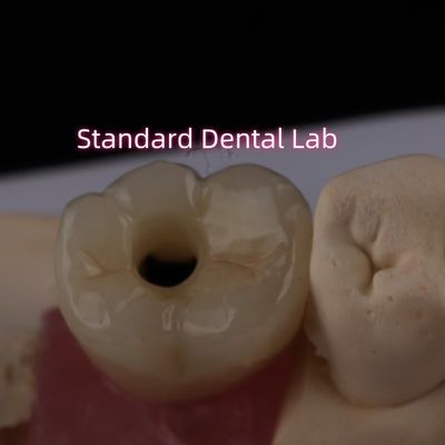 خرید ایمپلنت عقب تاج بروکسیر پیچ زیرکونیا جامد نگه داشته شده ساخت آنلاین
