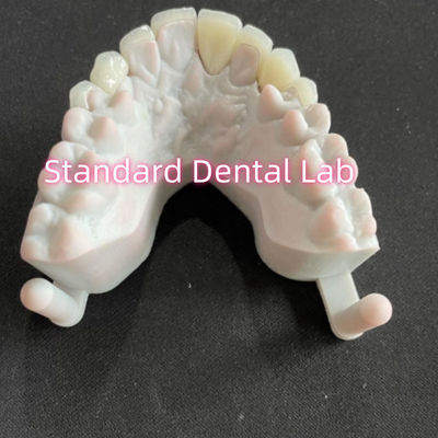 خرید دندانهای لبخند ستاره ها Emax Zirconia Laminate Veneers 0.6mm ساخت آنلاین