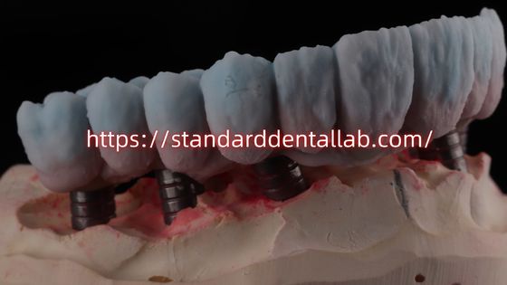 خرید پل زرکونی با ایمپلنت با تیتانیوم ساخت آنلاین
