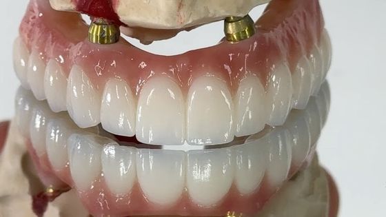 خرید دندانپزشکی همه در X ایمپلنت PFM تاج تیتانیوم ثابت دندان های مصنوعی ترکیبی ساخت آنلاین