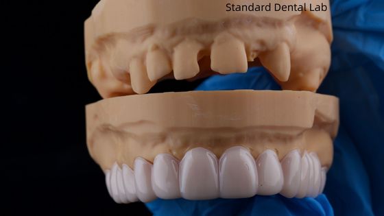 خرید استاتیک بالا دندانپزشکی Snap On Smile استاندارد لابراتوار دندانپزشکی دستگاه دندانپزشکی قابل برداشت ساخت آنلاین