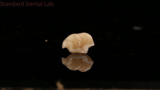 خرید قدرت Emax تاج سرامیکی دندانپزشکی Onlay با مقاومت بسیار عالی لکه چین آزمایشگاه دندانپزشکی ساخت آنلاین