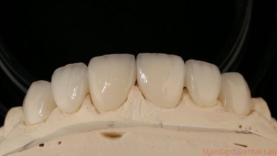 خرید پل تاج زرکونیا دقیق تناسب راحت / زیبایی 3-4 روز زمان برگشت سریع ساخت آنلاین
