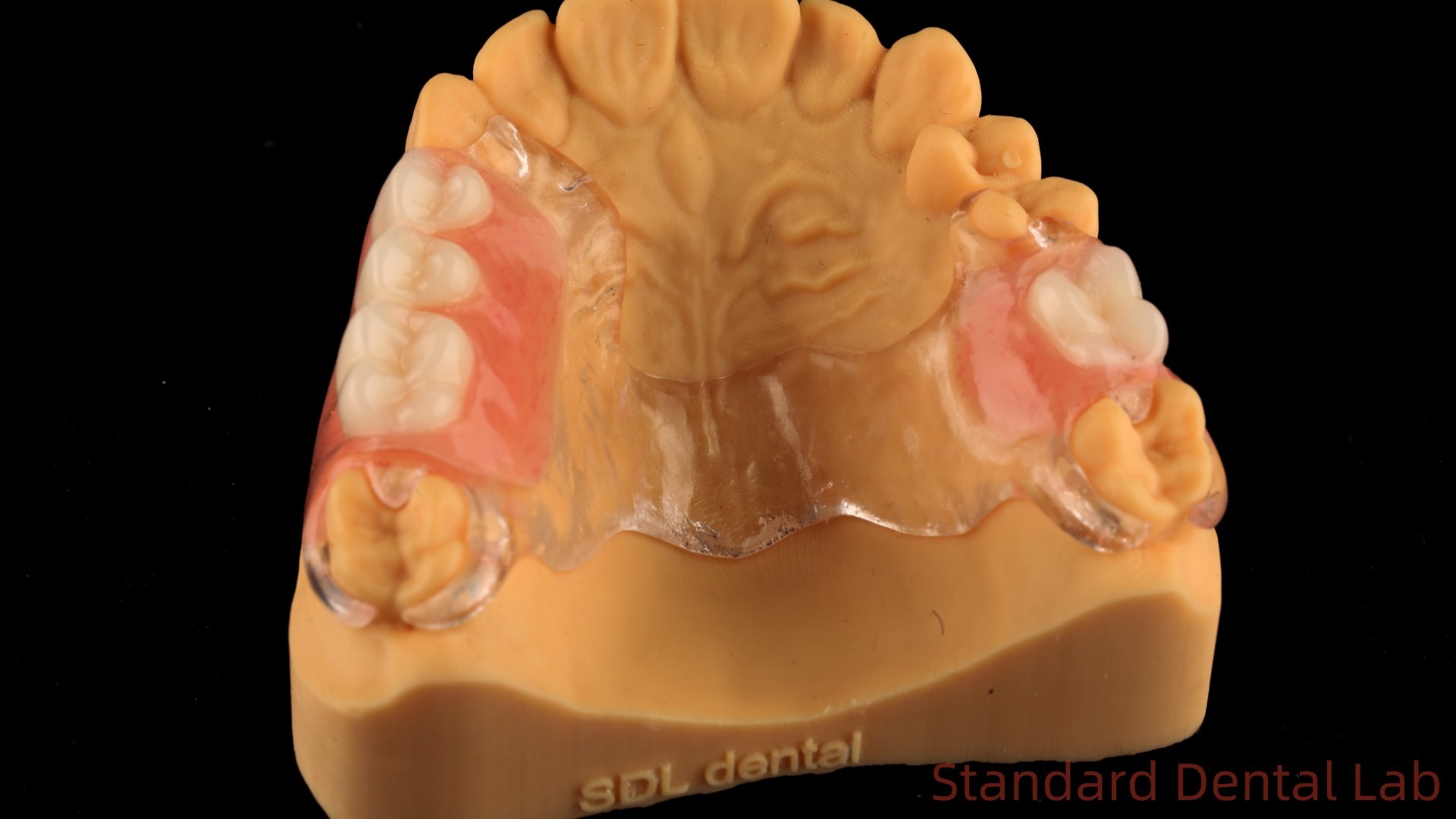 Flexible Partial Denture