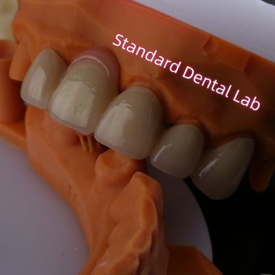 زرکونیا پرت شده از پورسلن PFZ با آدامس صورتی