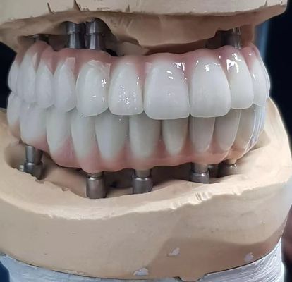 سیمان پیچ دار زرکونیا به دقت ساخته شده برای دندان های طبیعی