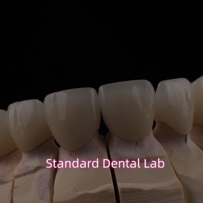 پل زرکونیا سرامیکی لایه دار دندانپزشکی PFZ با برش شفاف