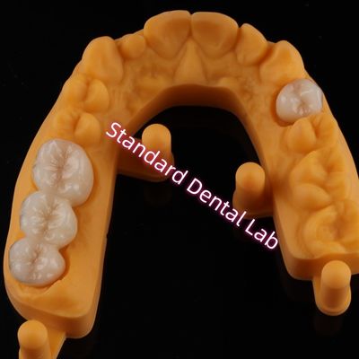 تاج تمام فرش سرامیکی زیرکونیا ایوکلار دندان زیبایی OEM