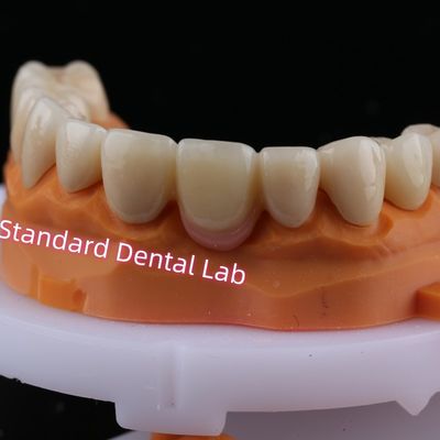 سنگ شکن دیجیتال CAD CAM تاج پل زرکونیا لایه دار با پورسلین صورتی