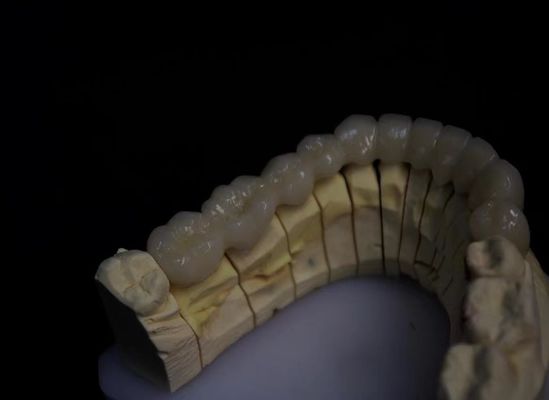 زرکونیا ذوب شده از پورسلین لایه دار