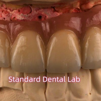 CAD CAM فریزینگ PFM پورسلین غیر گرانبها به پل ثابت فلزی ذوب شده