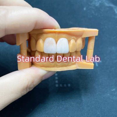 ثبات رنگی بالا Ivoclar Emax لامینات Veneers شفافیت بالا