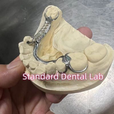 اسکلت کروم کاست پروتز فلزی