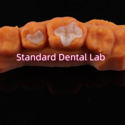 فرش دندانپزشکی Inlay Onlay Overlay Zirconia Emax Composite برای پوسیدگی دندان