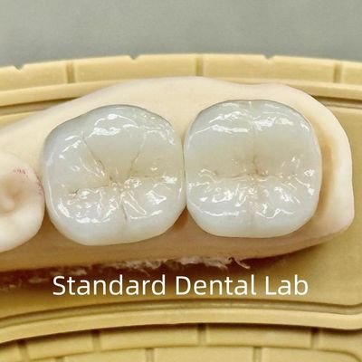 تاج های آزمایشگاهی دندانپزشکی شفاف و کامل زرکون با قدرت برتر