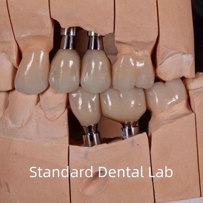 تاج ایمپلنت زیرکونیا با پیچ زیبایی طبیعی