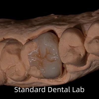شفافیت Emax Zirconia دندان های داخل آنلای تاج برای بازگرداندن شکل طبیعی حفره