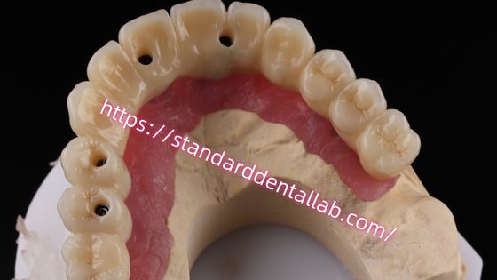 پل ایمپلنت با پیچ زیرکونیا چند لایه ای با ساختار فلزی سازگار است