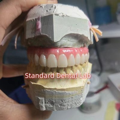 پیچ نگهدارنده تیتانیوم PMMA پل دندانی تاج موقت
