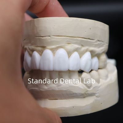 تاج دندانپزشکی تشخیصی موم کردن زیبایی بالا از آزمایشگاه دندانپزشکی چین