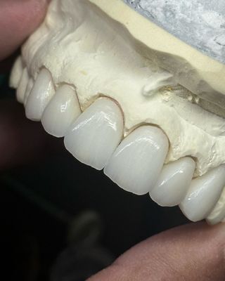 تاج زیرکونیا لایه ای شفاف برای عملکرد بهینه و زیبایی طبیعی