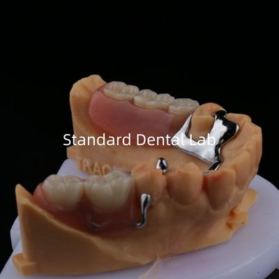 آلیو فلز بخش دندانی چارچوب 3 شکل Exocad لیزر چاپ پایین گداخته بخش پایان