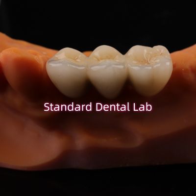 تاج های آزمایشگاه دندانپزشکی دیجیتال CAD CAM تاج زرکونیا لایه دار شفاف
