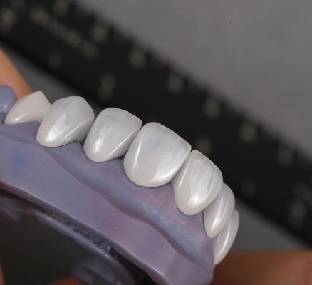 ظاهر طبیعی Emax Veneers تاج سازگاری زیستی رنگ سفید کننده با حداقل آماده سازی