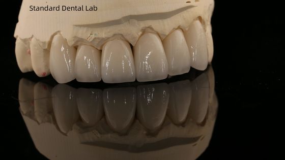 تاج زيرکوني و پل دنداني طبيعي 5 سال گارانتي