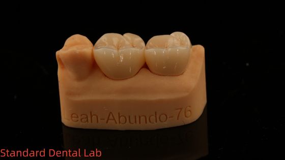 تاج های آزمایشگاهی دندانپزشکی جامد 3D پرو تاج های زیرکونیای کامل با 5 سال گارانتی
