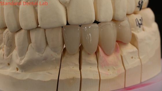 تاج های آزمایشگاهی دندانپزشکی جامد 3D پرو شفافیت بالا تاج های زیرکونی کامل با سایه ویتا سفارشی