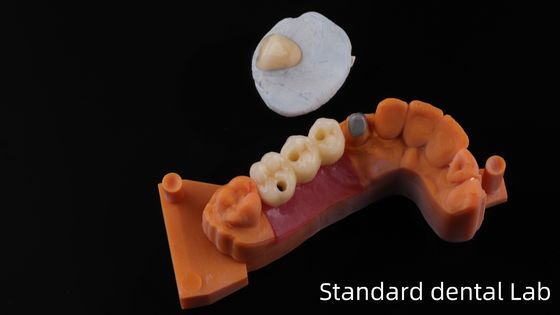 آزمایشگاه دندانپزشکی پست کور از چین / هسته پست فلزی با تاج PFM