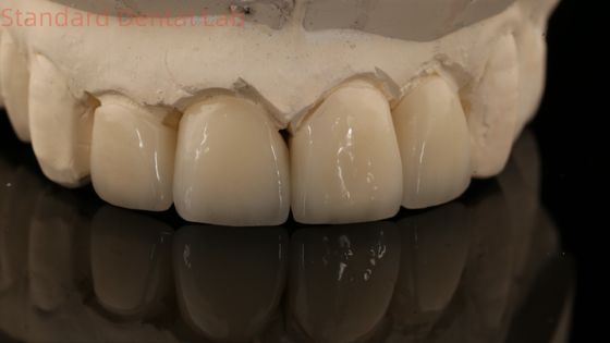 تاج و پل زيرکونياي پرت قوي در زيرکونياي پرت چين لابراتوار دندانپزشکي