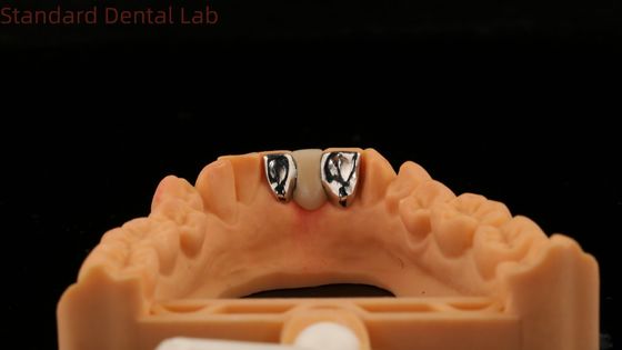 دندانپزشکی PFM پل مریلند زیبایی عالی FDA با Vita Porcelian China Dental Lab تایید شده است