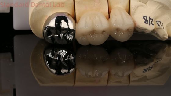 تاج فلزي پورسيلاني و 3 سال گارانتي از آزمايشگاه دندانپزشکي