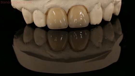 تاج زيرکوني و پل دنداني طبيعي 5 سال گارانتي