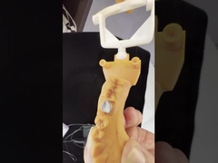 تاج زرکونیا با شکل کامل/ زیبایی عالی پل دندانپزشکی زرکونیا