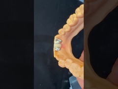 دندانپزشکی PFM پل مریلند زیبایی شناسی بالا FDA گواهینامه