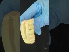 تاج زرکونیا با شکل کامل/ زیبایی عالی پل دندانپزشکی زرکونیا